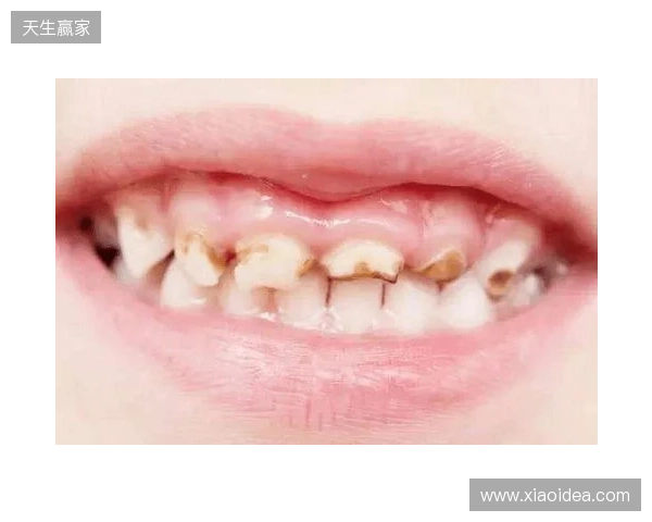 韦林顿确诊上唇部贯通伤；11、21牙半脱位；上颌前牙区牙槽骨骨折